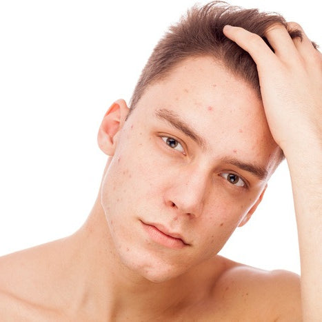 unhappy man observes acne on his face